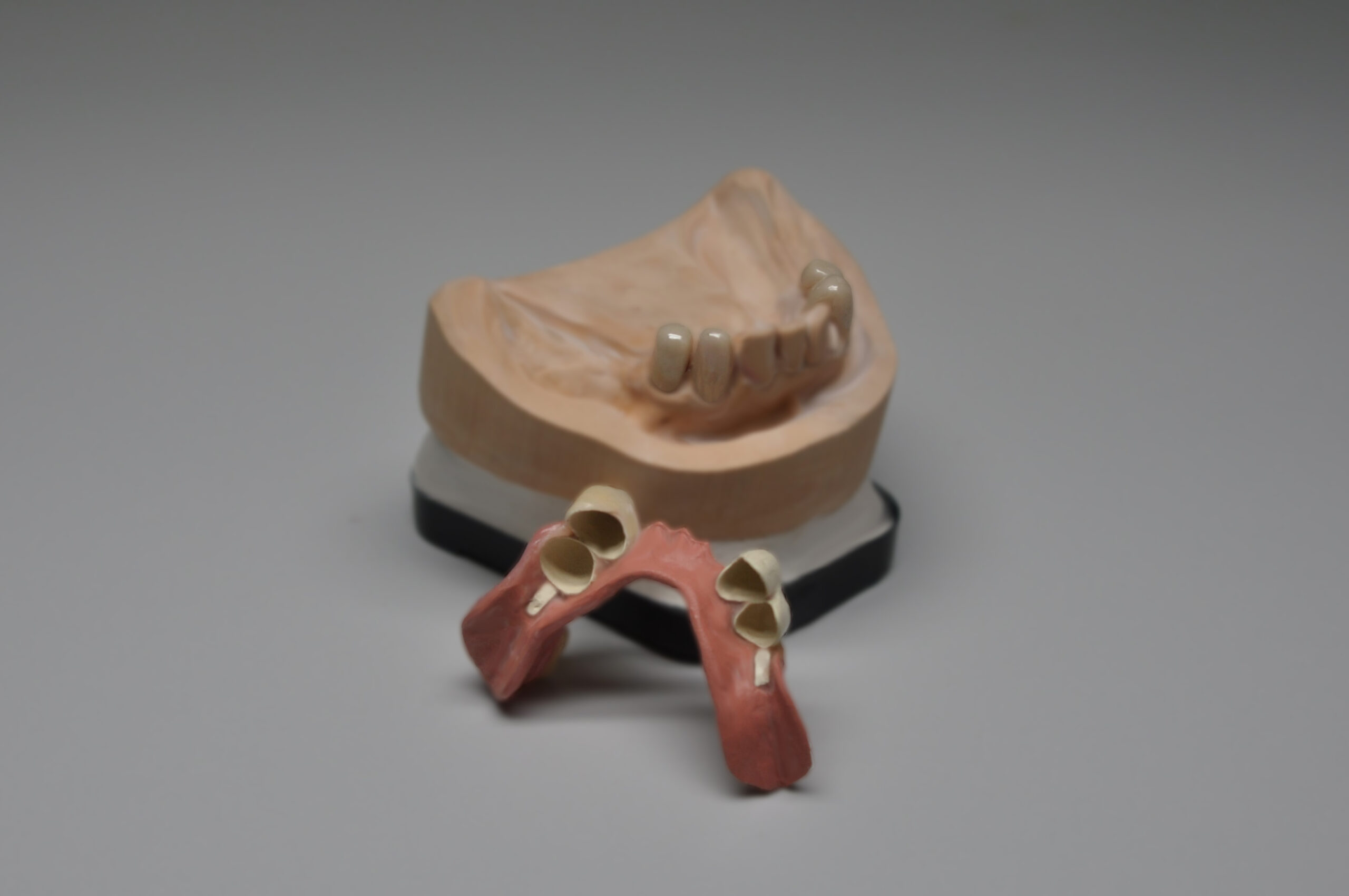 Lösung für Allergiker: Biokompatibler, metallfreier Zahnersatz